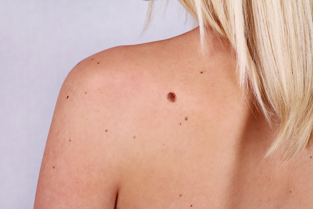 Why you should get that mole examined