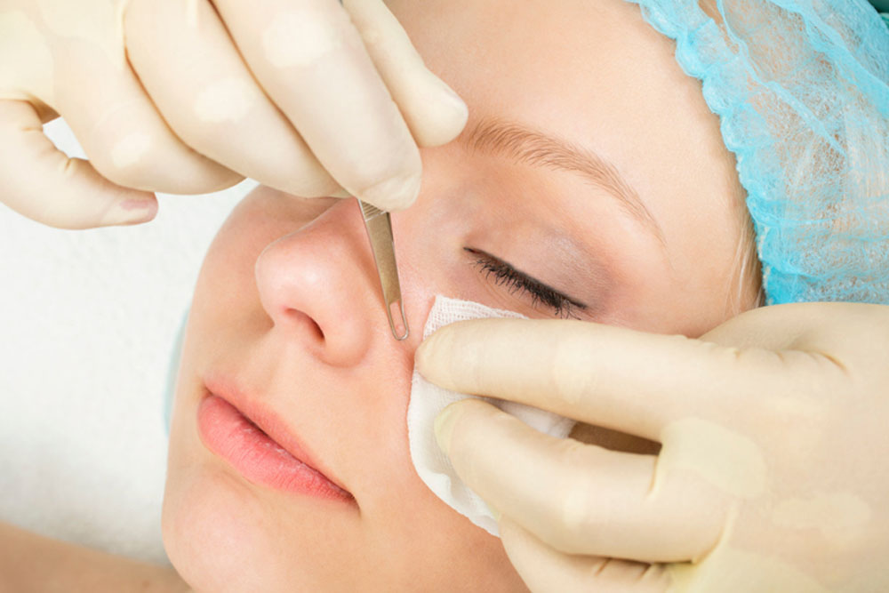 How to prevent blackheads