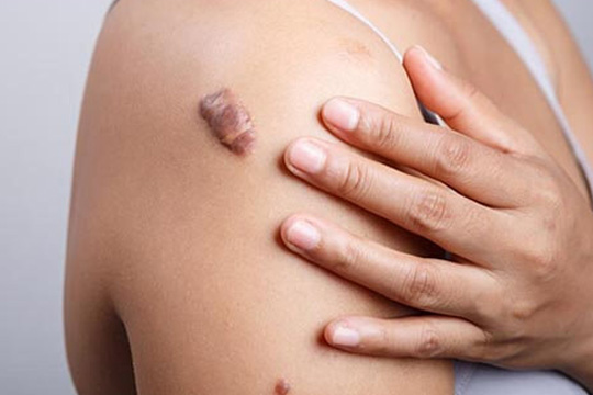 Keloid Treatment Gurgaon
