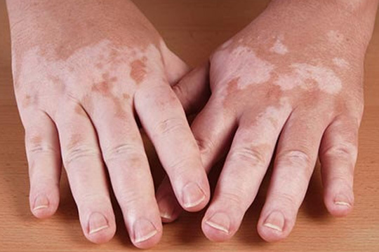 Vitiligo Treatment Gurgaon