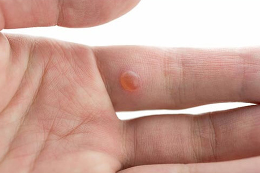 Wart Removal Treatment in Gurgaon