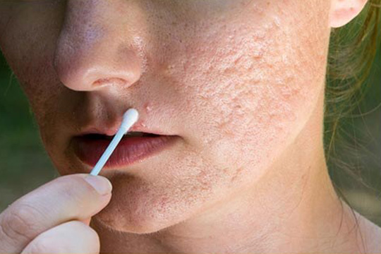 acne scar treatment gurgaon